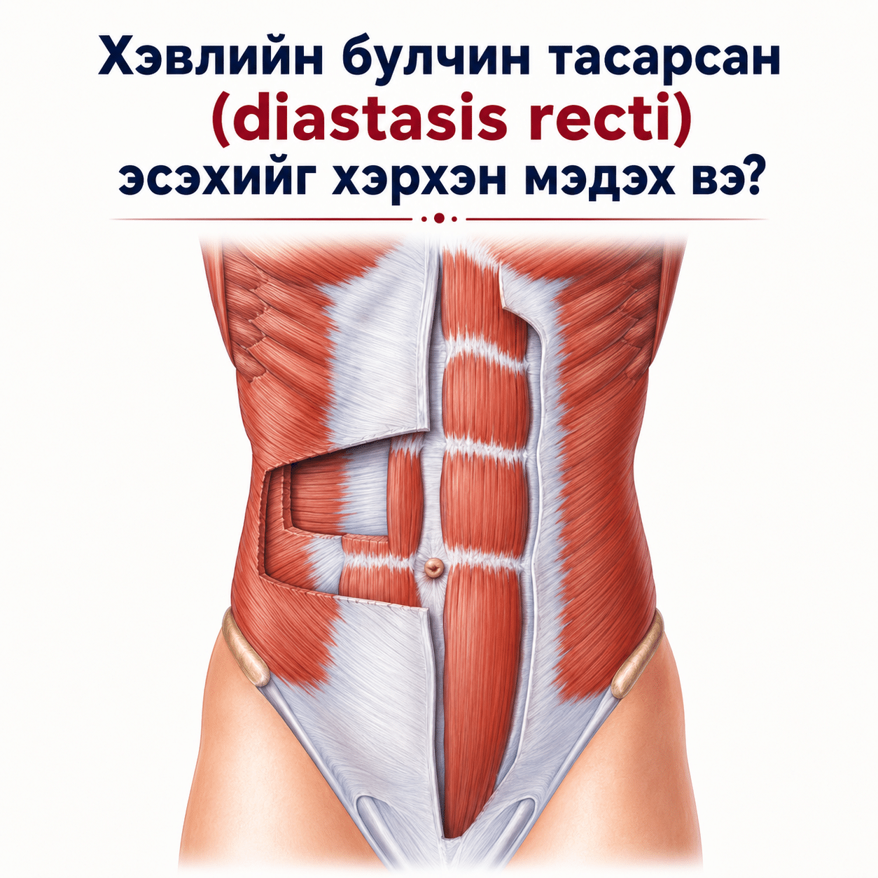 Хэвлийн булчин тасарсан (diastasis recti) эсэхийг хэрхэн мэдэх вэ?